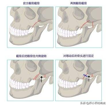 高颧骨是不是不好看，人家却说这就是高级脸。。